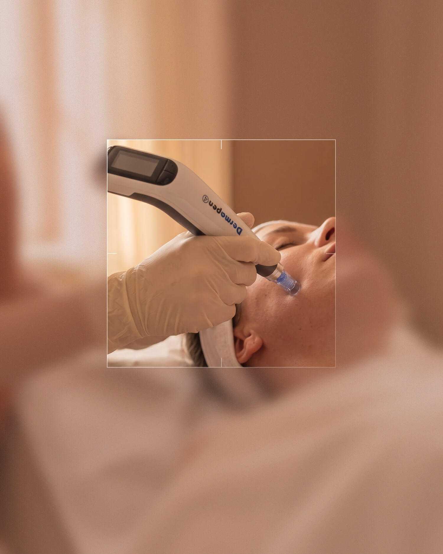 Person mit weißem Stirnband liegt entspannt auf Behandlungsliege während eine zweite Person mit Handschuhen ein Dermapen-Gerät an der Gesichtshaut ansetzt
