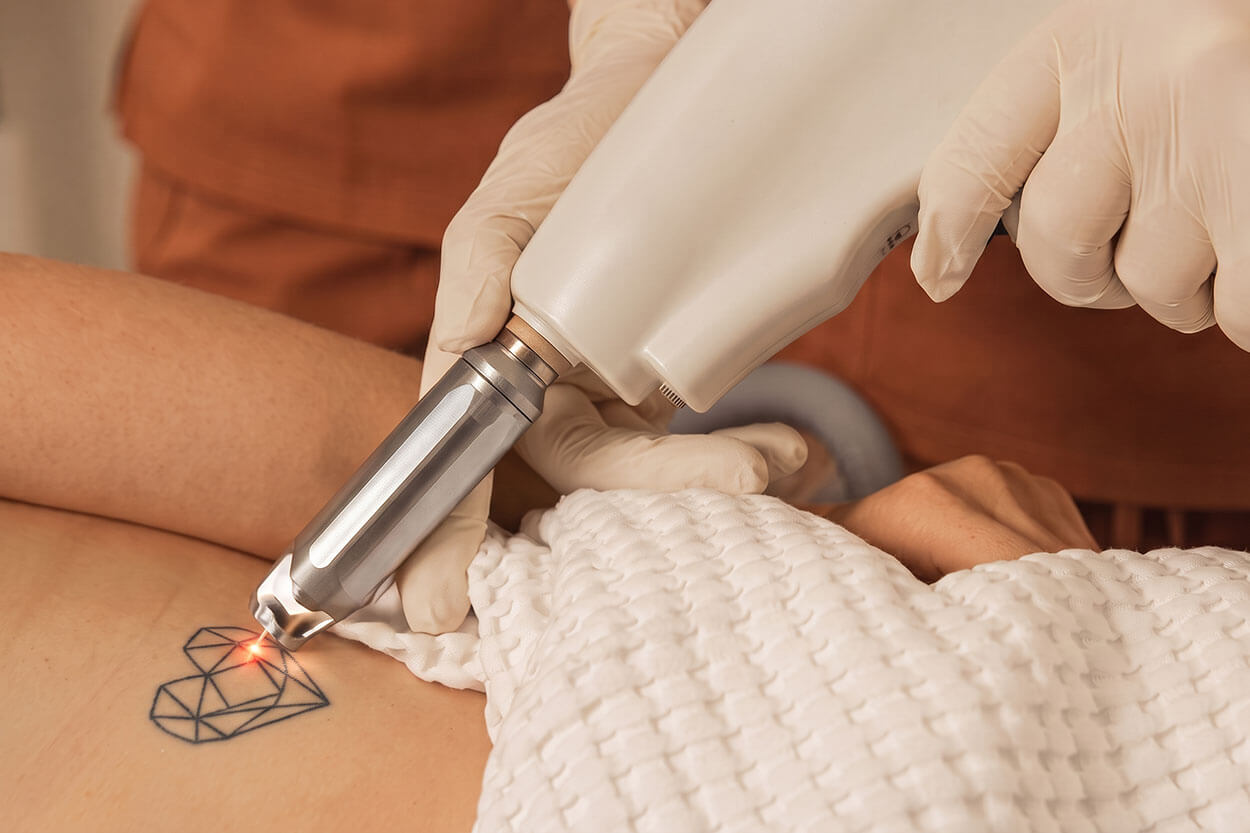 nouvada_hautarzt_trier-health_compass-tattooentfernung_dermatologie-header-1250x833