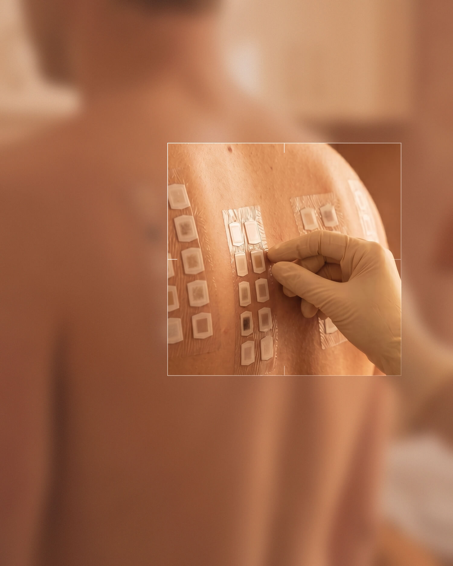 Rücken eines Mannes mit mehreren allergischen Pflastertests, eine Hand mit Einmalhandschuhen berührt einen der Pflaster