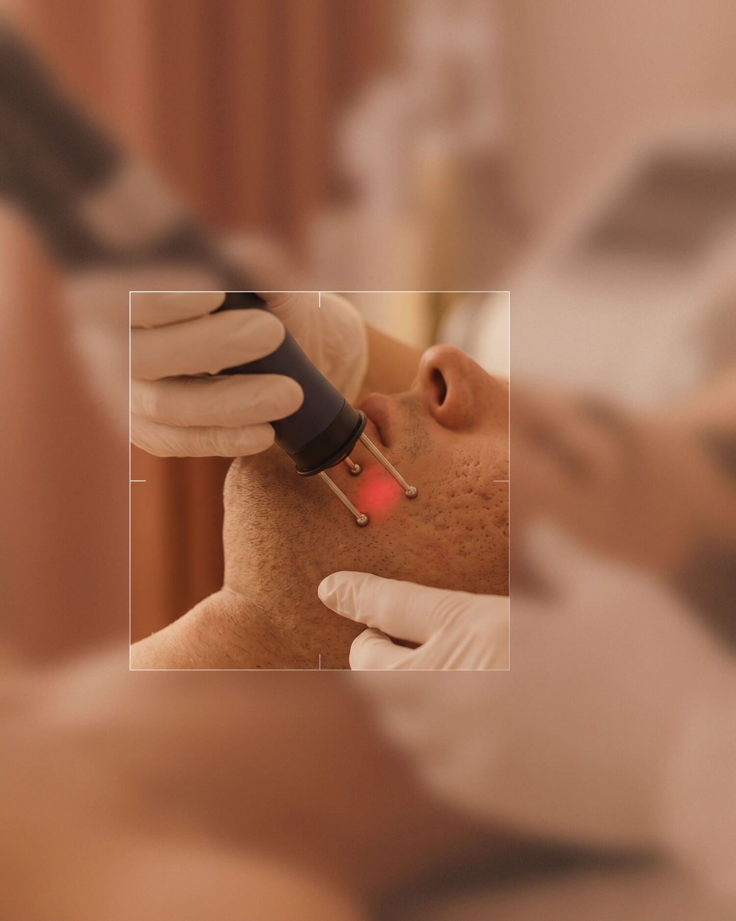 Nahaufnahme eines Mannes mit geschlossenen Augen, der eine Laserbehandlung im Gesicht erhält, während eine Person mit Handschuhen das Gerät hält und die Haut berührt
